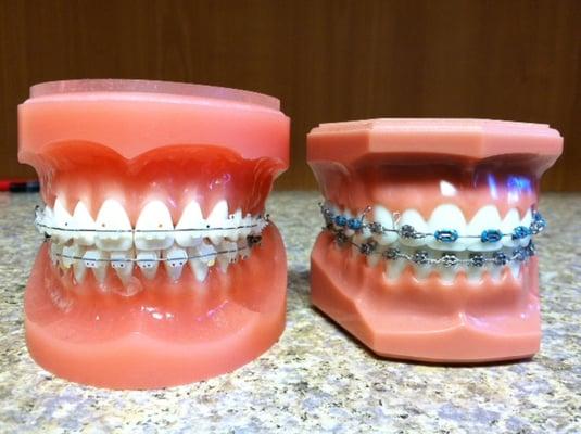 Clear ceramic brackets vs. Traditional brackets