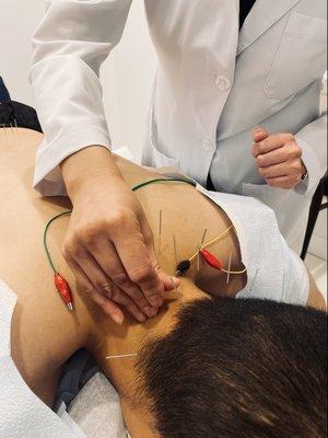 E-acupuncture