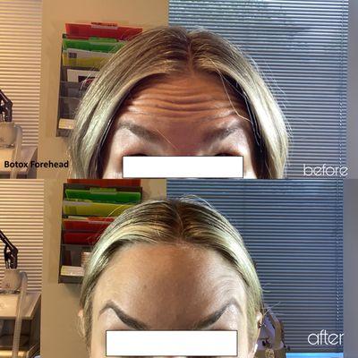 Botox forehead before and after photos