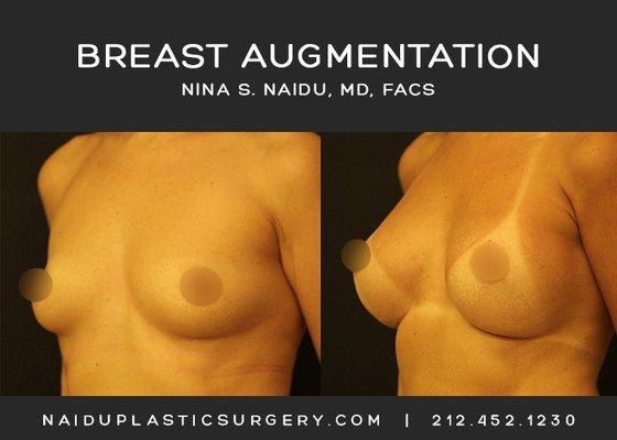 Nina S. Naidu, MD FACS  (212) 452-1230  http://www.naiduplasticsurgery.com   IG: https://www.instagram.com/drnaidu_plasticsurgery/