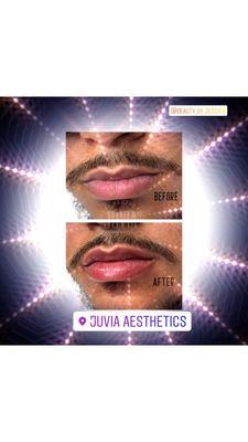 Lip enhancement for him..