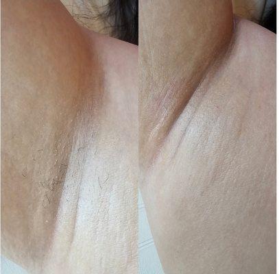 Underarms before and after