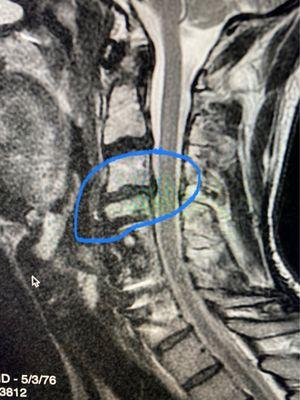 Discs out of place and causing excruciating pain above surgical area where vertebra was removed due to tumor.