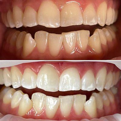 Before & after teeth whitening - double session