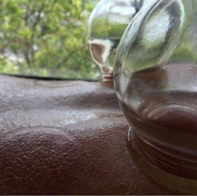 Close Up of Traditional Glass Cupping