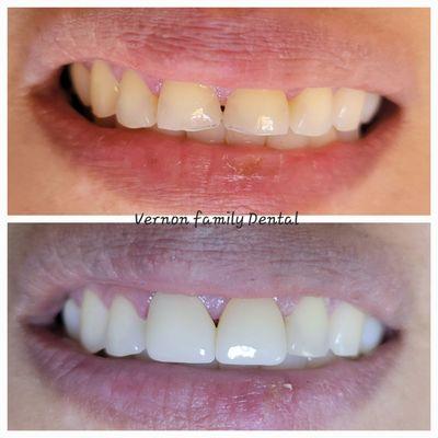 Placing two front zirconia crowns.