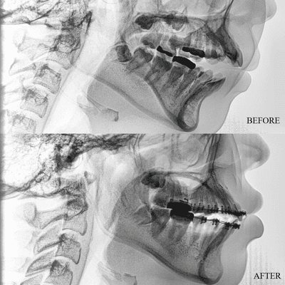 Proper habit control and orthodontic treatment, her anterior open bite was eliminated in 9-12 months. Patient's speech has significantl