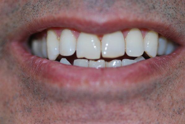 Before Upper and Lower Veneers