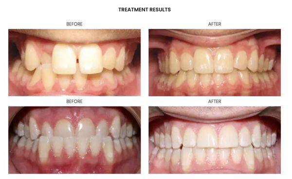 Invisalign Before & After Photos