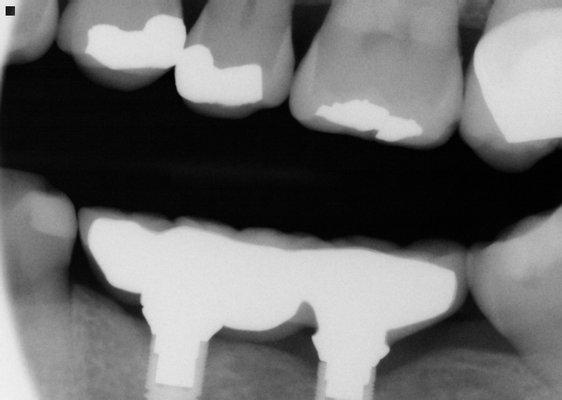 Implant Bridge...