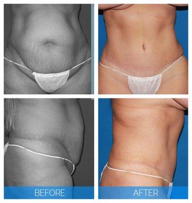 Great tummy tuck results for this patient 9 months post-op.