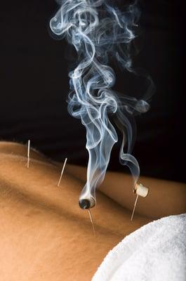 Needle warming using moxibustion