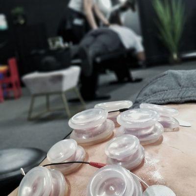 Cupping Treatment