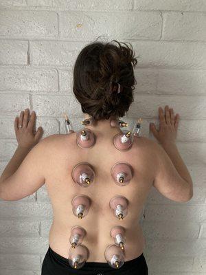 cupping session