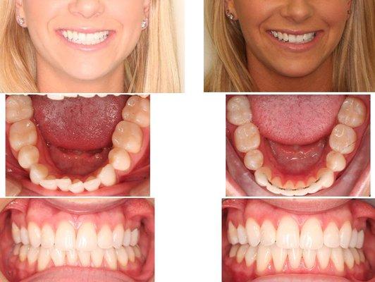 We like to use a semi permanent retainer on the lower anterior teeth to help maintain final positioning. Great results, Jirusha!