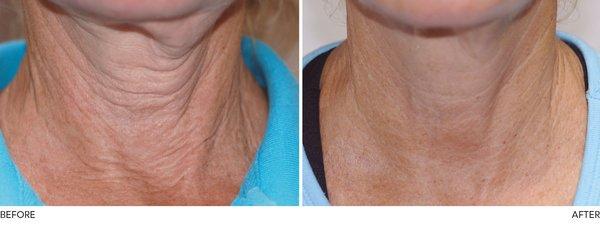 Exilis Elite Treatment on the neck. A Non-Invasive Body Contouring and Skin Tightening.