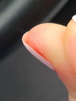 Bleeding underneath and on sides of nails after manicure