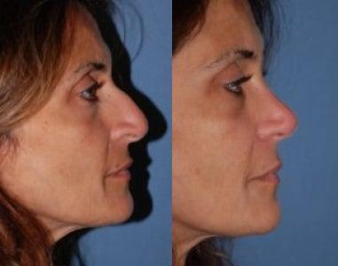 Rhinoplasty before and after