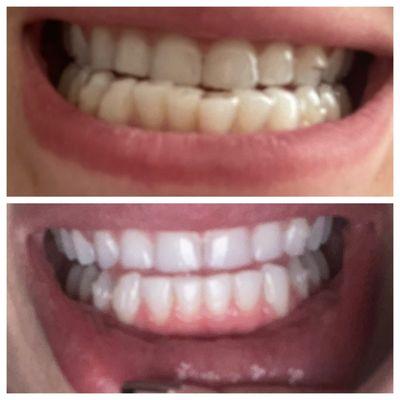 About a year with Sure Smile aligners.