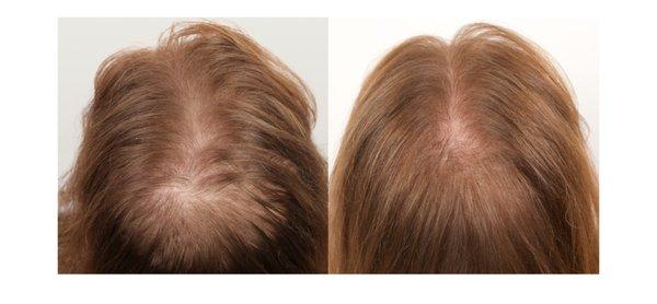 PRP hair restoration