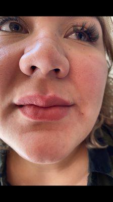 Dermal fillers-lips