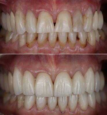 Enhancing a lovely patients smile/confidence