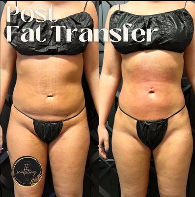 Post fat transfer