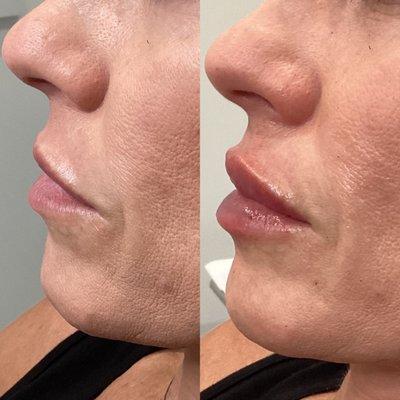 BEFORE+AFTER: Look at this transformation! Lips injected by our RN Sarah!