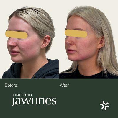 Limelight Jawlines is a holistic approach to sharpening the jawline.