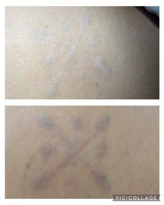 Tattoo removal after 3 sessions