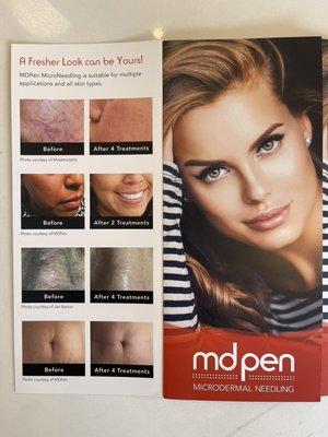 MTS treatment for Acne / big pore/stretch marks