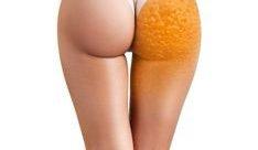 Reduce cellulite with cavitation and radiofrequency