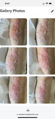 Skin problems 6 visits of acupuncture treatment resulted