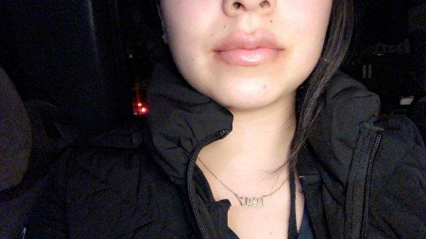 Lip fillers