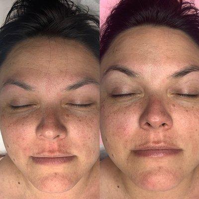 Before and after dermaplaning facial