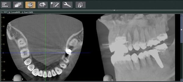 3D radiographic scan