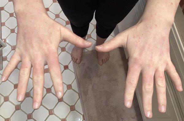 This is what my hands look like now (13 months into getting help from Ann Tam and stopping use of topical steroid ointment).