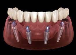 Implant-Supported Denture