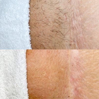 Before and After Brazilian Sugaring Treatment