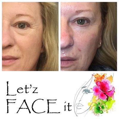 INCREDIBLE improvement in upper & lower eye laxity, as well as overall skin texture/tone (after 2 VIVACE RF microneedling treatments)