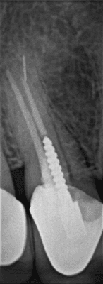 Broken drill bit ia seen at the root of the tooth