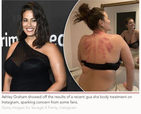 Ashley Graham showed off results of recent gua sha body treatment. Getty Images for Salvage X Fenty, Instagram