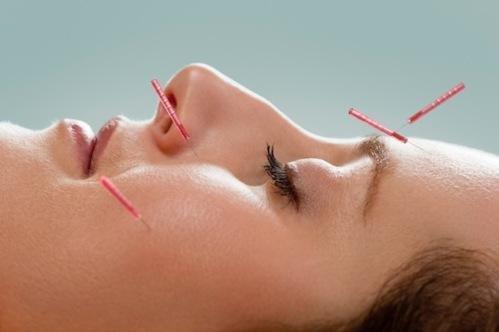 Cosmetic acupuncture - an alternative to Botox