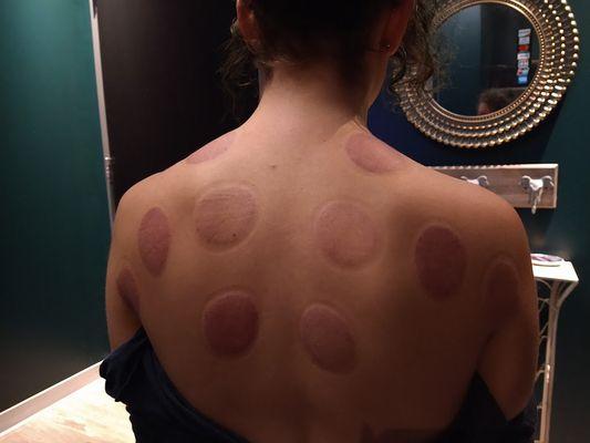 Cupping