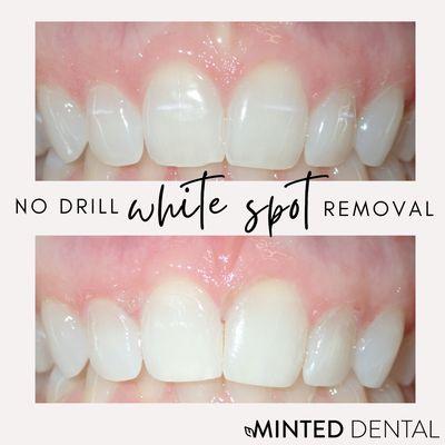 Permanent white spot removal - check out our instagram @minteddental for lots more of these! NO DRILLING!