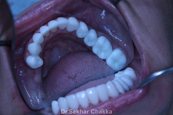 Case 15 a: Dental implant (pre-op)