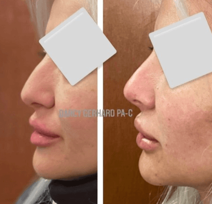 Non surgical nose job with dermal filler