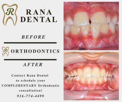 Before and After Braces