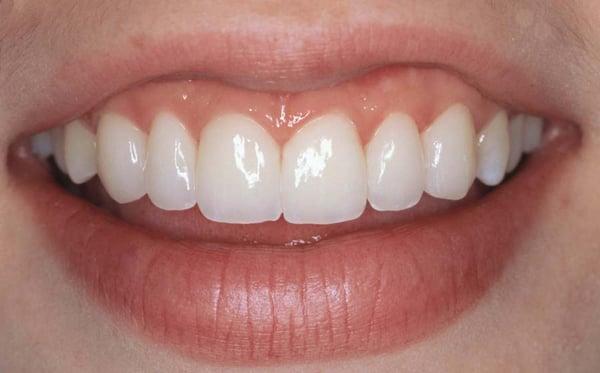 Porcelain Crowns and Veneers