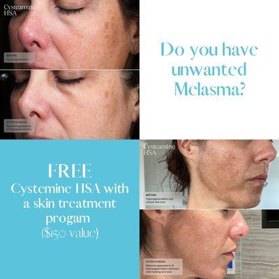 Melasma treatment!!